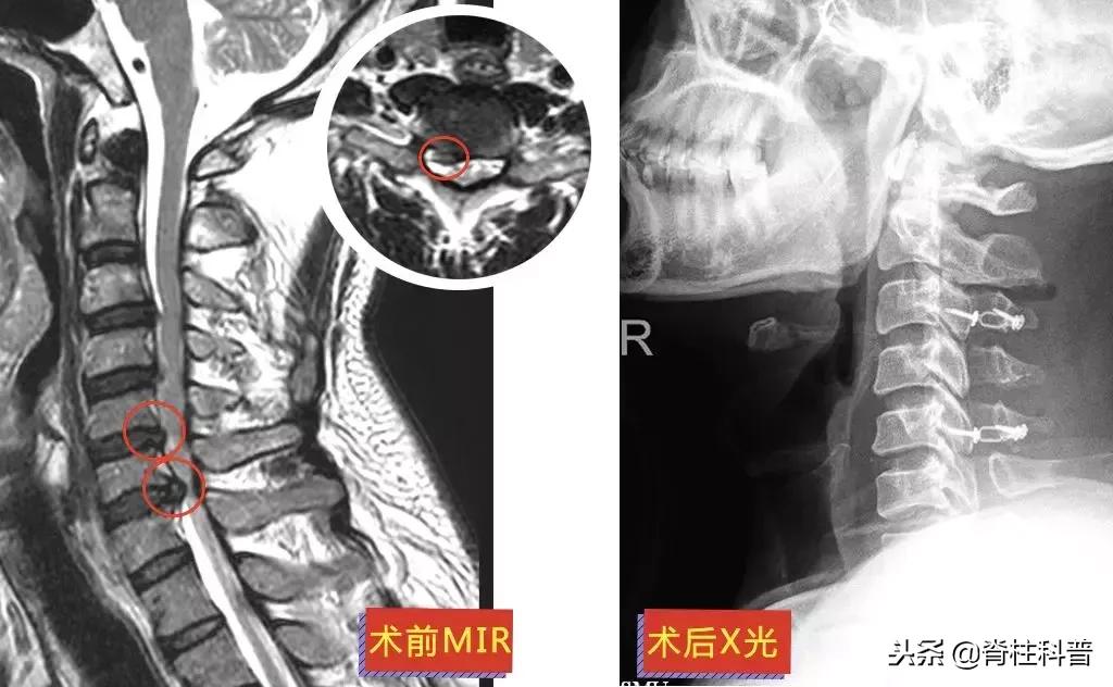 颈椎病治疗的分享,关于颈椎病通俗易懂的科普