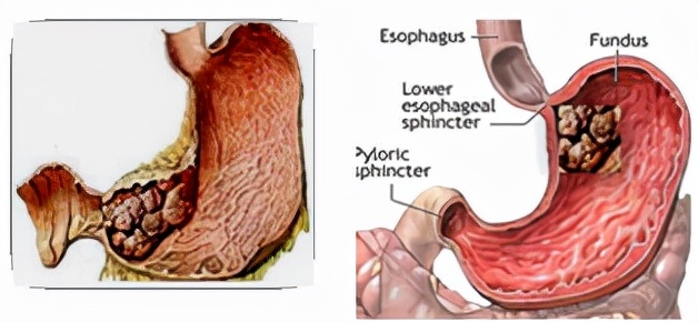 我不是药神,我不是财迷!若患胃癌,这些靶向药你有能力负担吗?
