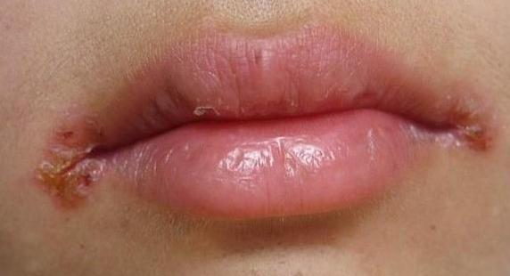 皮肤科外用软膏大全脂溢性皮炎,常见的皮肤科药