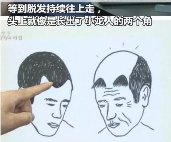 遗传的脂溢性脱发有得治吗,脂溢性脱发是否可以植发