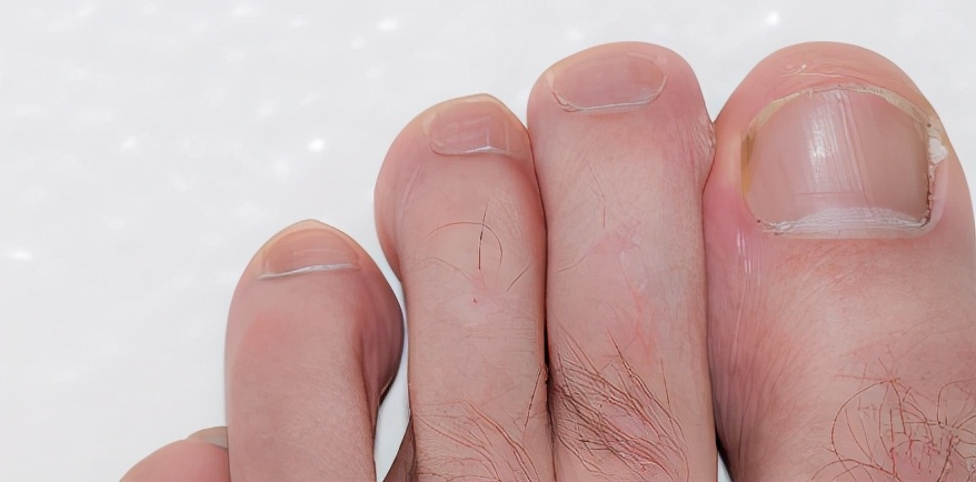 治灰指甲要验血吗,医院检查灰指甲挂号什么科