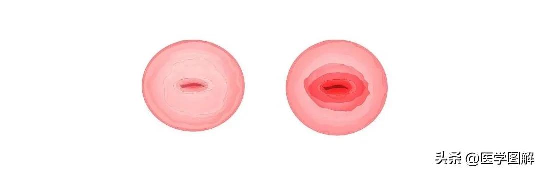 肉眼能判断宫颈糜烂,医生肉眼判断宫颈糜烂