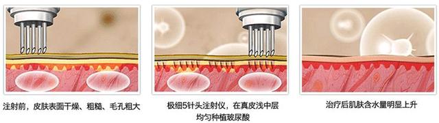玻尿酸胶原蛋白的功效与作用,玻尿酸的功效医美