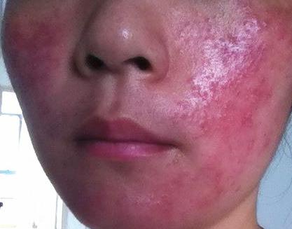 脸上长痘用手挤掉留的印子,脸上长痘怎样用粉刺针清理痘痘