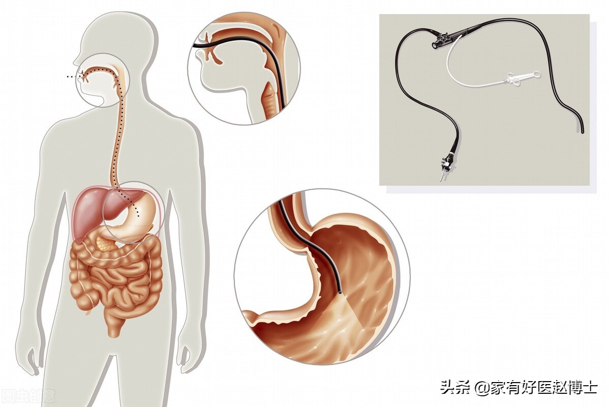 最常见5类息肉每个人都可能有，哪些无癌变风险，哪些需要切除？