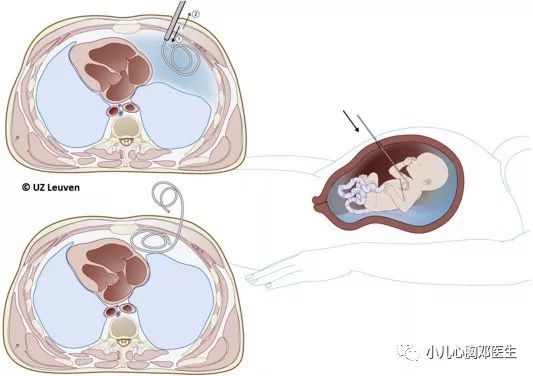 胎儿胸腔积液怎么办,36周胎儿胸腔积液