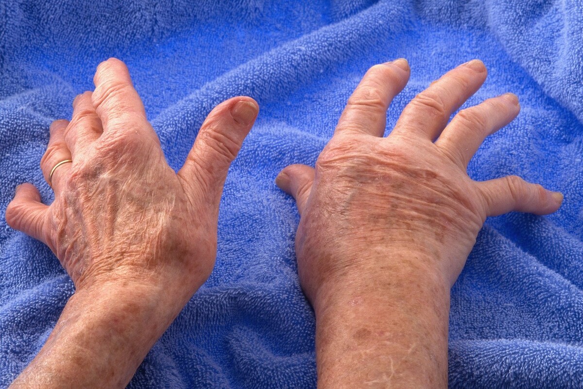 风湿类疾病怎么治疗,风湿瘤是什么症状