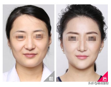 5000元的线雕和5000元线雕的区别,5万元线雕价格