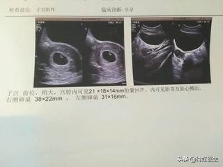 医生说流产术后恢复的不好,流产后怀疑没有流干净检查什么