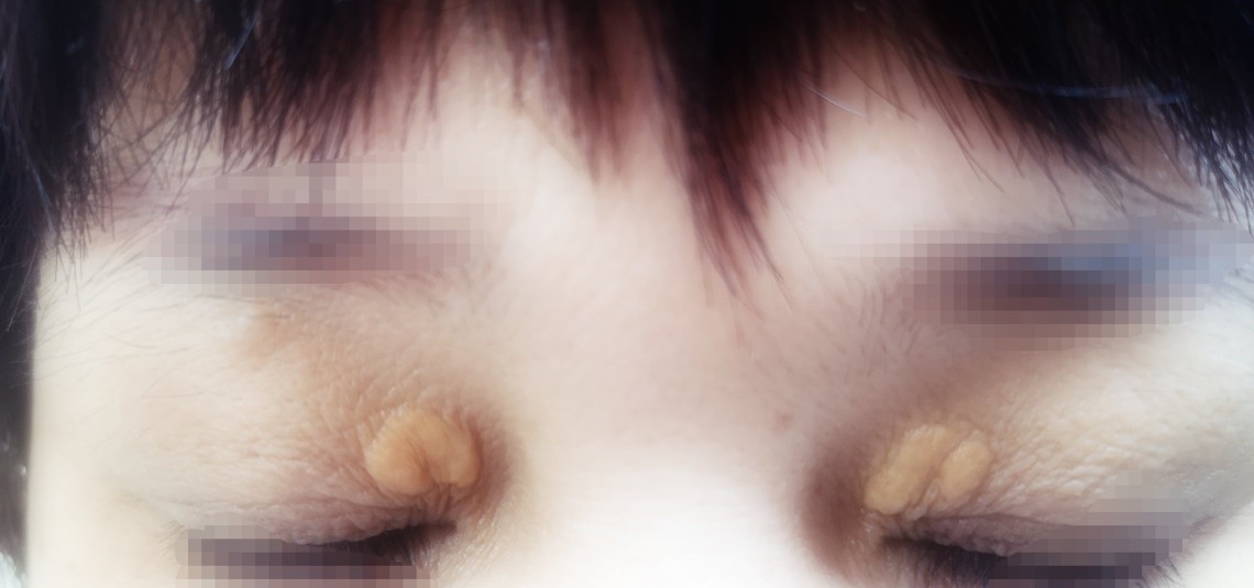 眼角长黄色肉疙瘩，是怎么回事？医生提醒：可能血脂有异常！