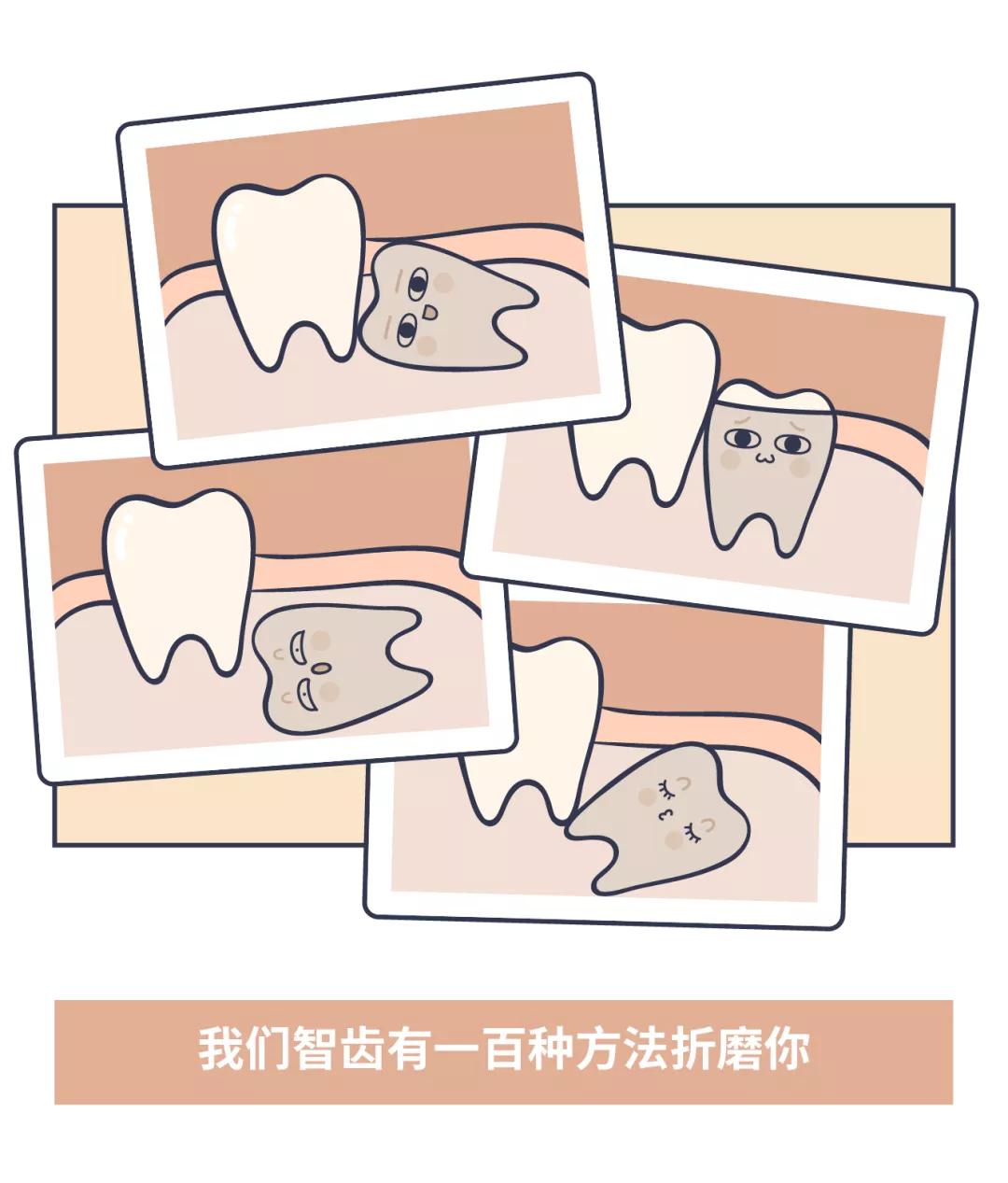 智齿拖着不拔的人有的截骨了,如果有炎症的智齿断根不拔能行吗