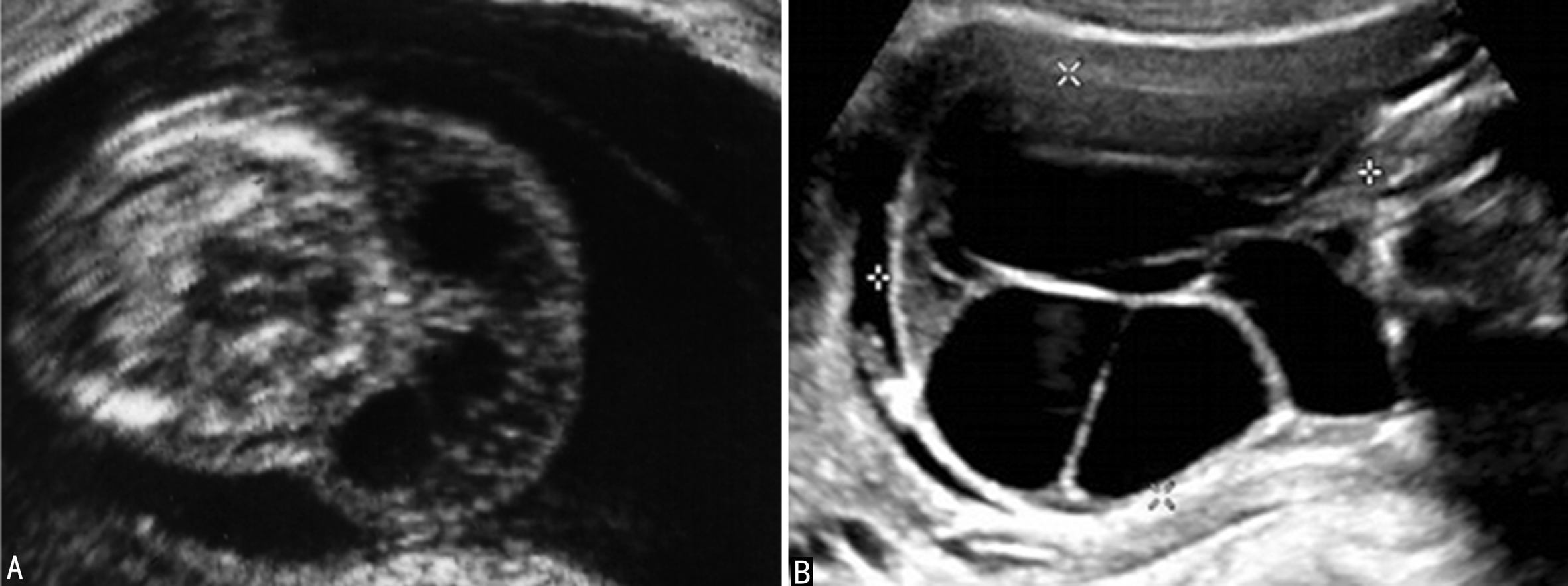 孕晚期胎儿染色体检查与基因检查,孕中期染色体异常超声指标