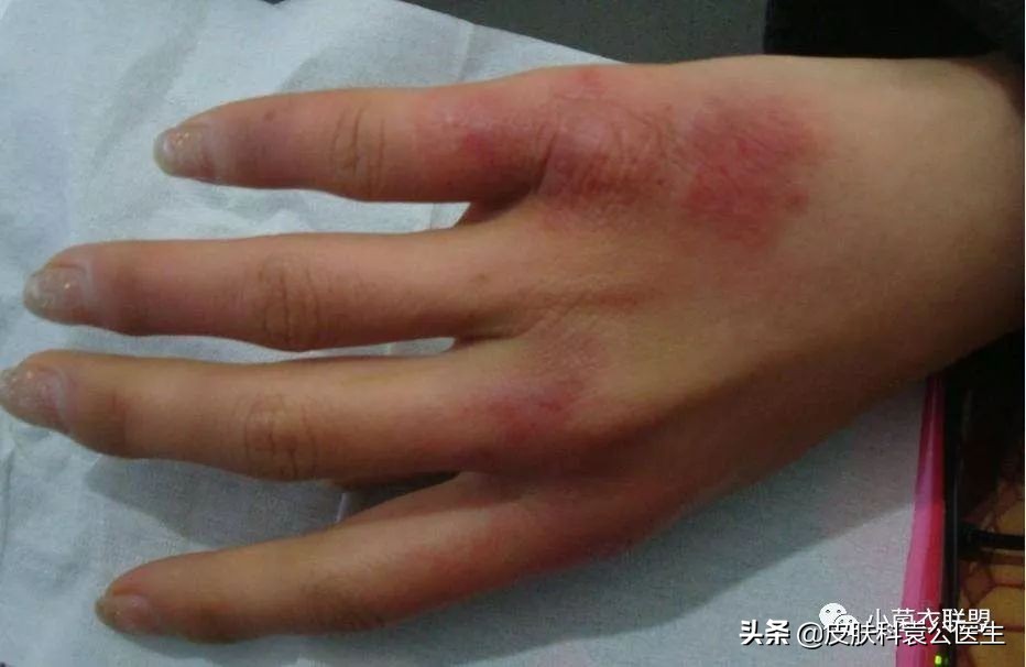 冻伤后痒痒是怎么回事,冻疮后期接触水干燥发痒怎么治