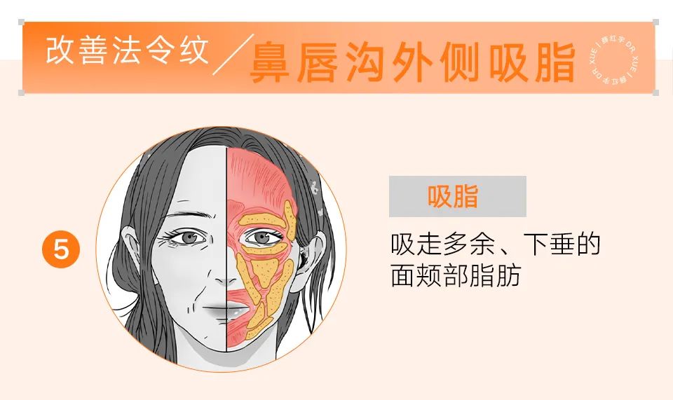 脾胃好了法令纹会改善吗,面部瑜伽能改善法令纹吗