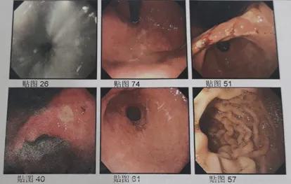 从胃炎到胃癌需要四步,从胃炎到胃癌往往出现这4个迹象