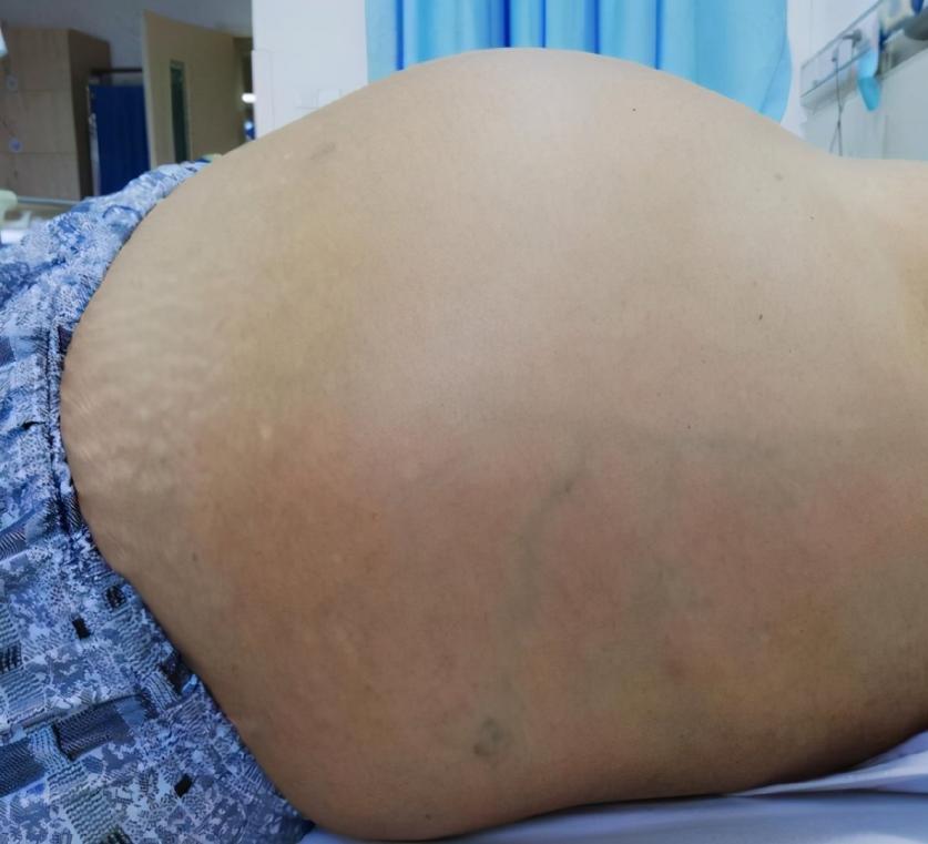 早期肝腹水怎么治疗好得快,肝腹水怎么治能断根吗