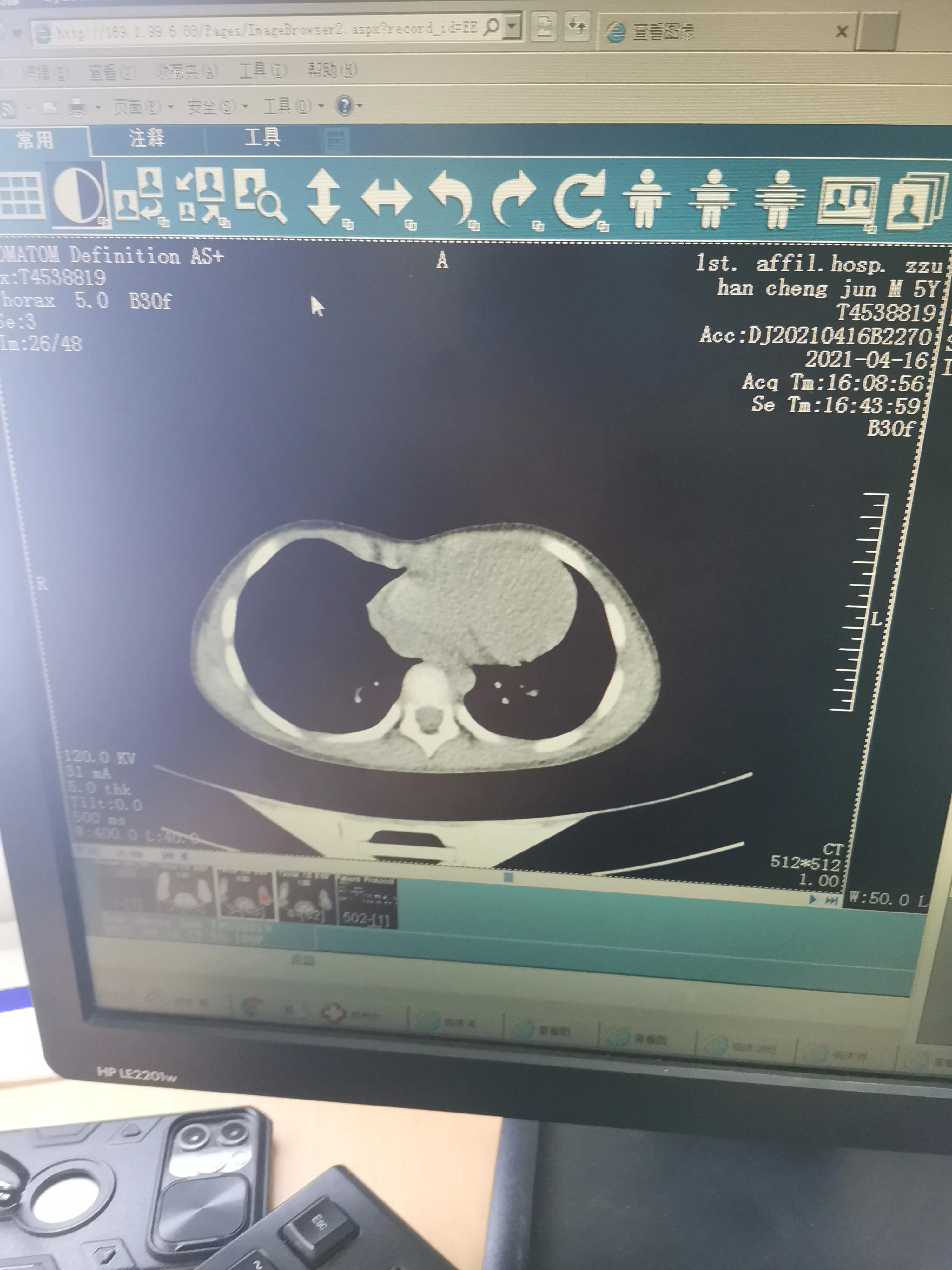 女儿漏斗胸怎么办,漏斗胸患儿家长有什么认识误区