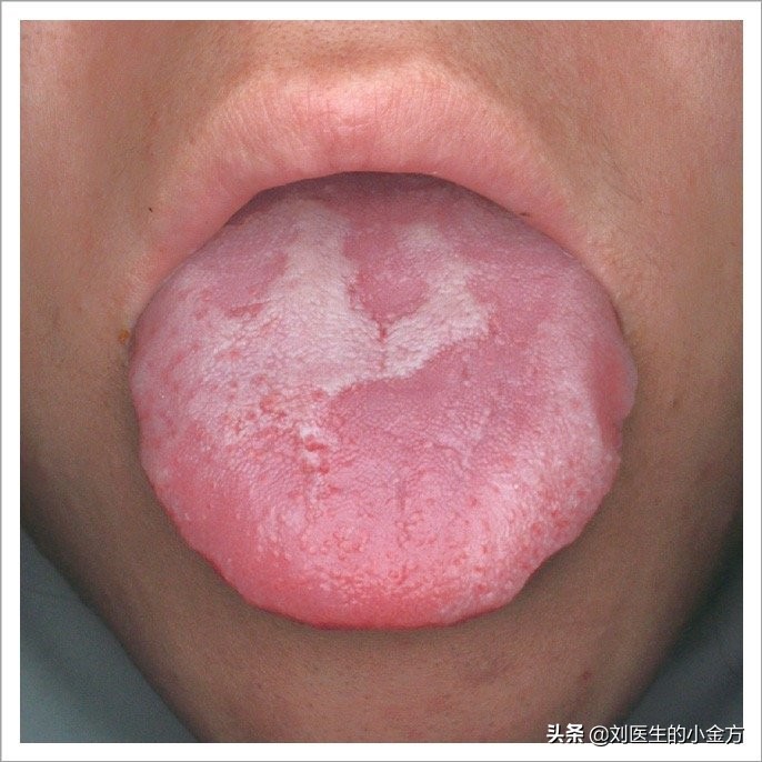 中医舌诊对照表100例,舌诊辨九大体质