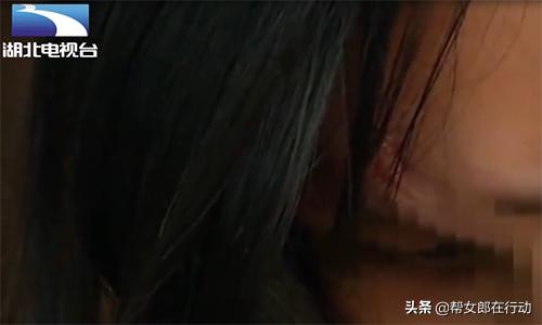 整形失败眼睛失明,女子微整形导致失明