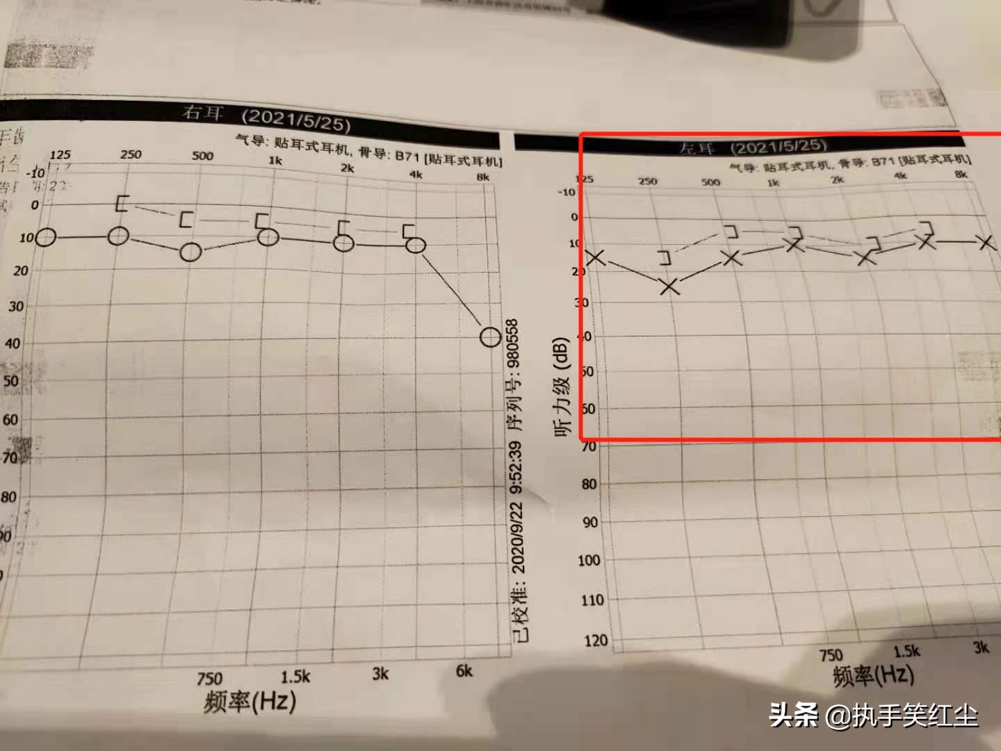 突发性耳聋治愈最新方法,左耳突发性耳聋是什么原因导致的