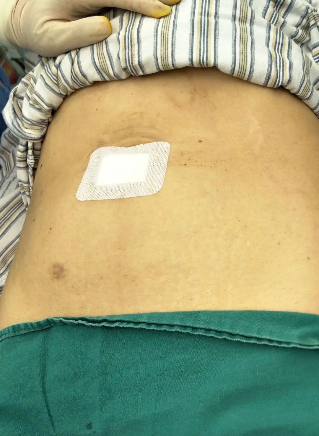 另辟“脐”径让伤痕隐形----我院妇产诊疗中心成功开展第一例单孔腹腔镜手术