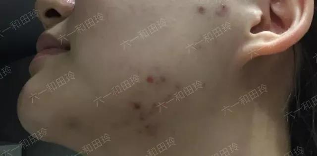 祛痘医美项目真实效果,祛痘印的医美项目对比