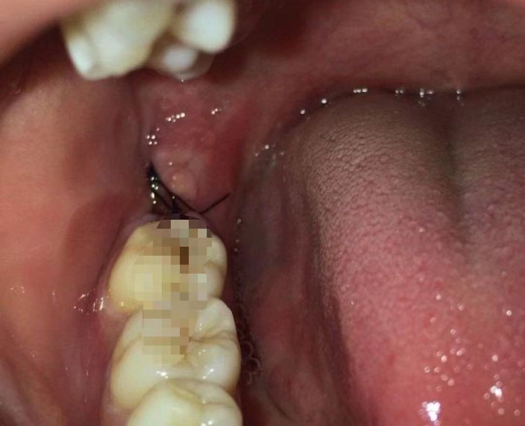 下颌阻生智齿拔除要流多少血,下颌低位水平阻生牙拔除图解