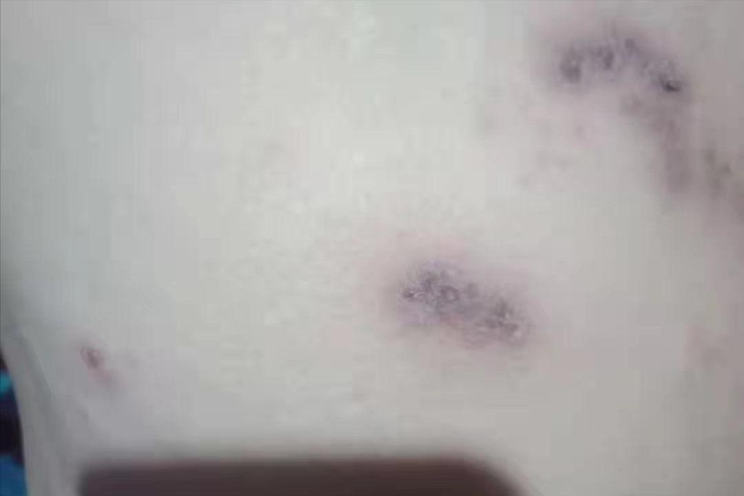 生殖器疱疹会误诊为带状疱疹吗,带状疱疹引起腰痛误诊分析