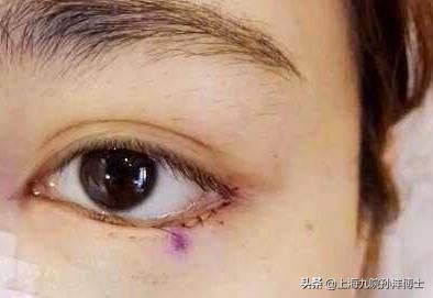 孙沣眼修复有成功案例么,眼修复能找原来医生修复吗