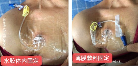 输液港不回血但输液通畅怎么办,输液港维护没有回血怎么回事