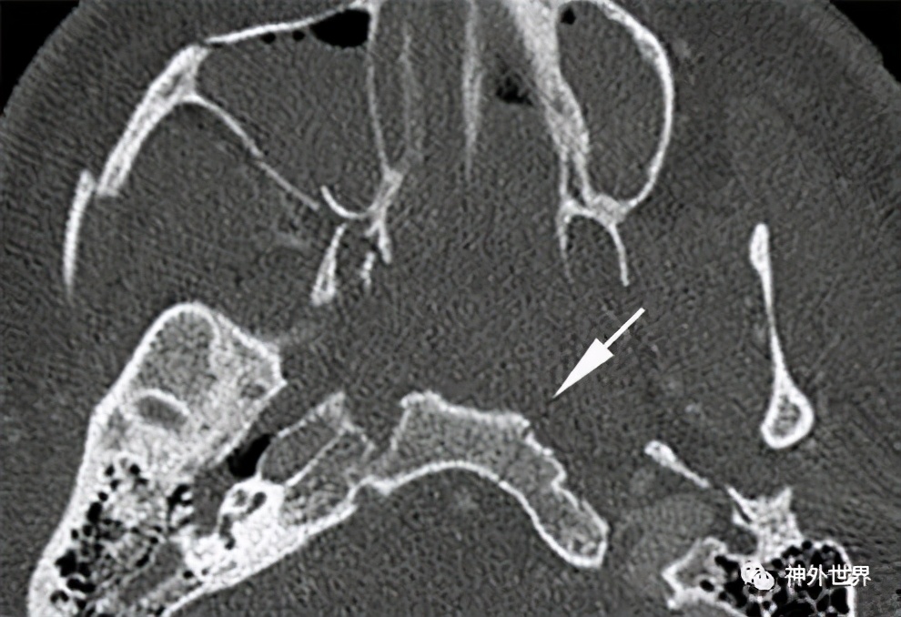 颅底骨折合并脑脊液漏伤情鉴定,颅底骨折伴脑脊液漏右眼眶骨折