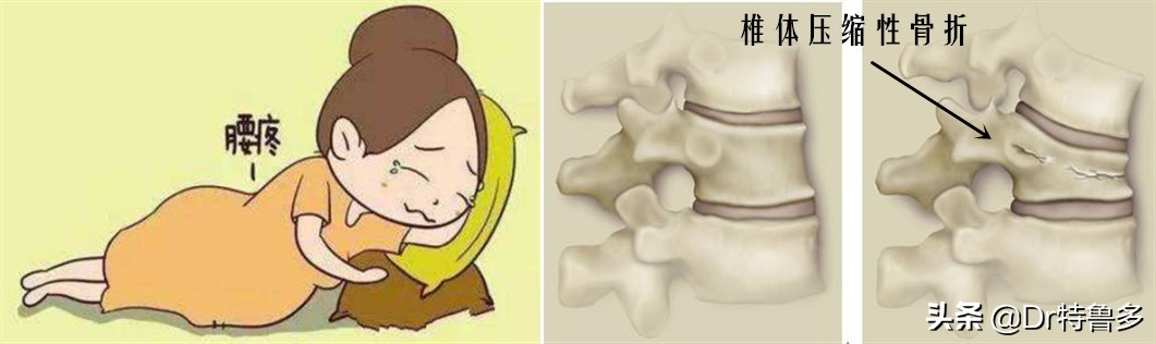 哺乳期女性补钙但是仍然骨质疏松,哺乳期妇女重度骨质疏松