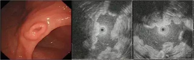 胃镜胃粘膜下隆起严重吗,胃镜提示粘膜下隆起病变