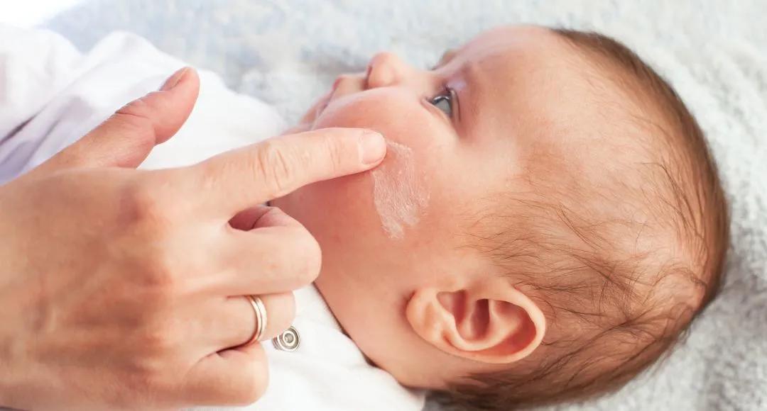 宝宝霜能治疗湿疹吗,宝宝用弱效激素治疗湿疹