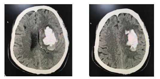 神经外科脑出血微创手术,微创神经介入治疗脑出血后遗症