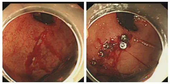ESD术后出血？饮食很重要