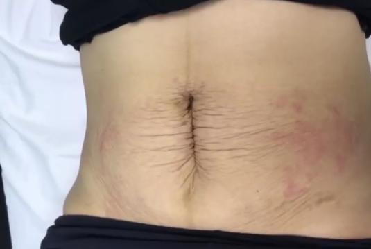 产后肚皮像橘子皮一样,产后肚子圆圆的像个球