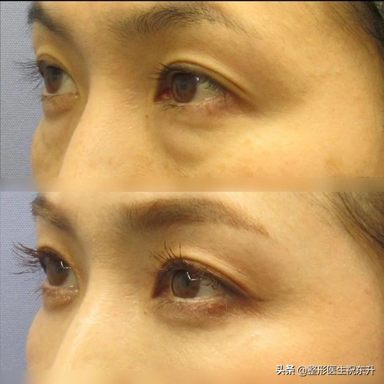 医生科普祛黑眼圈眼袋,祛眼袋医生怎么说