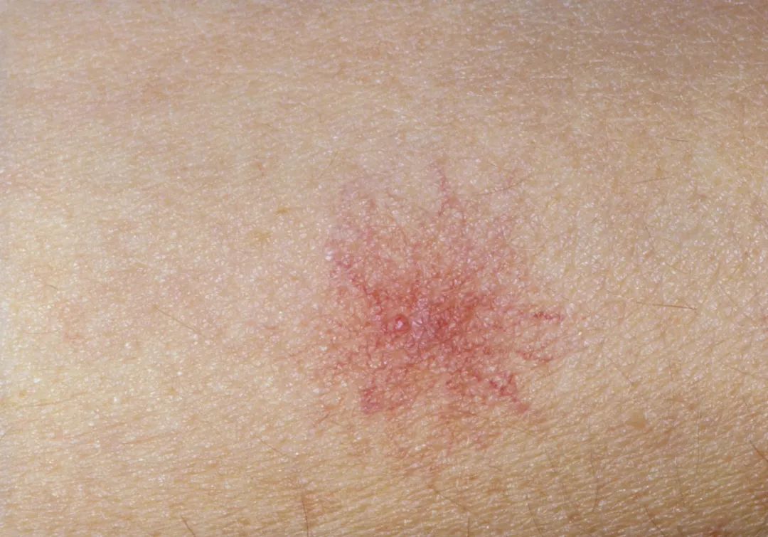 身上突然长了很多红点怎么回事,身上突然长很多小红点是什么原因