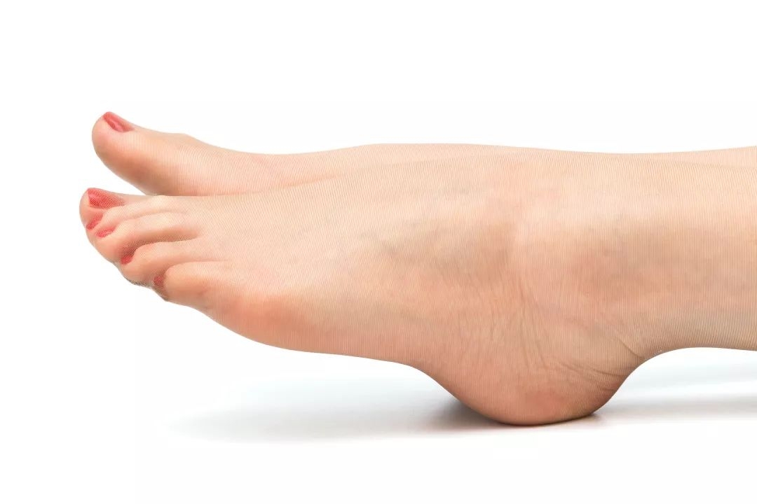 足跟疼走几步后疼痛缓解,解决足跟痛只需要2个小妙招