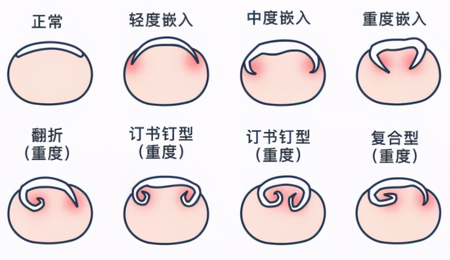 甲沟炎好痛怎么办,甲沟炎又疼又难受教你一招解决