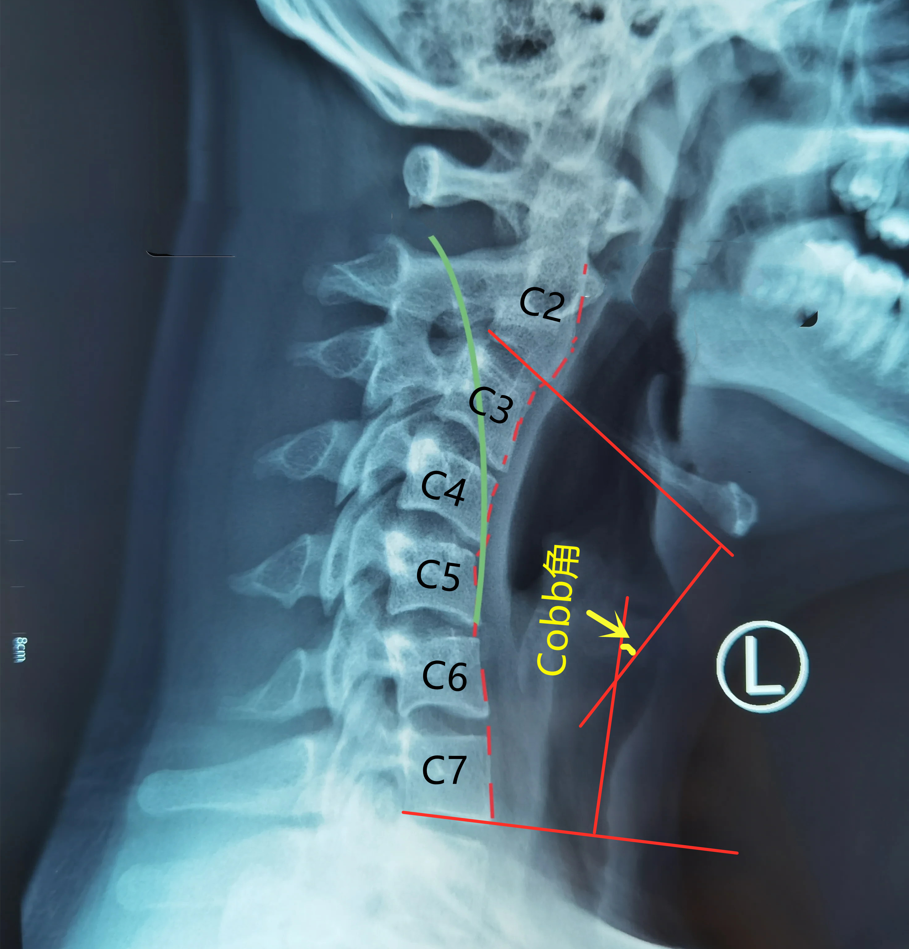 颈椎生理曲度过曲是啥意思,颈椎生理弯曲变直反弓怎么治疗