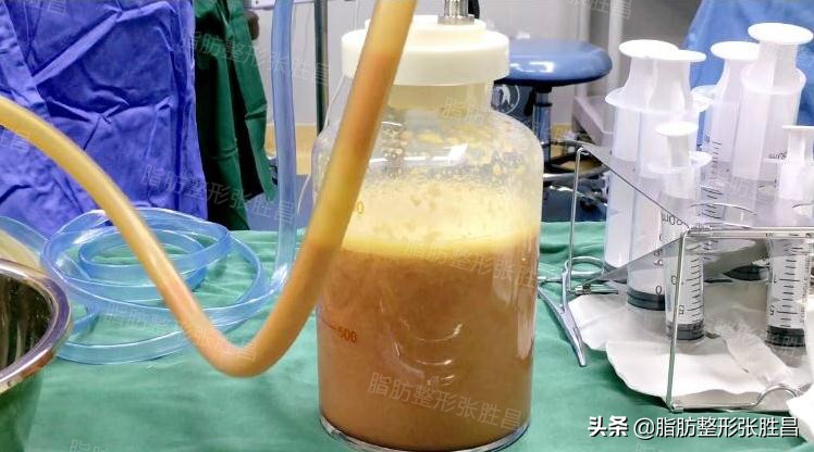 为什么吸脂会吸出血水是失败了吗,吸脂血水多有效果吗