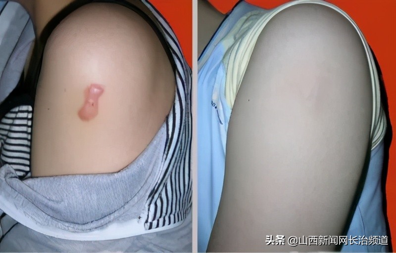 长治第二人民医院祛斑多少钱,长治二院激光手术