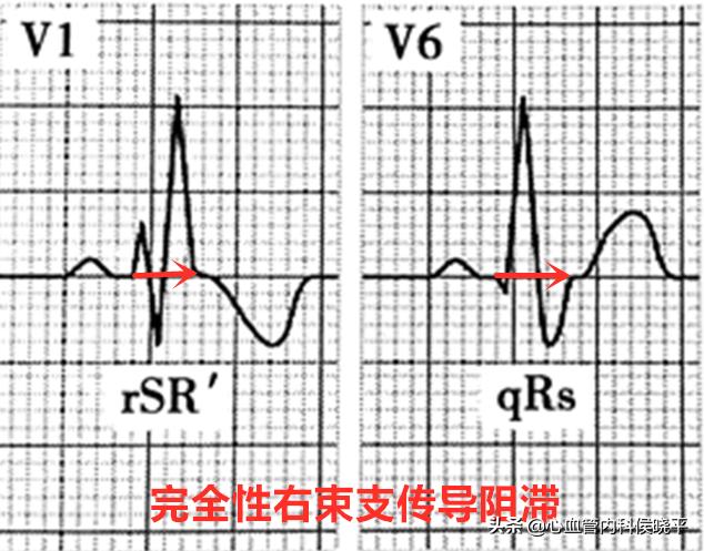 心脏右分支阻滞是怎么回事,心脏右束支传导不完全阻滞的危害