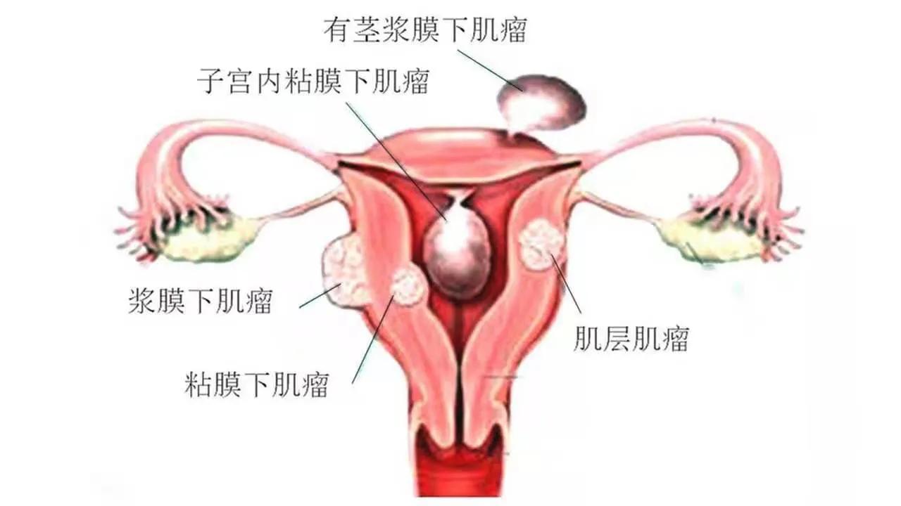 鸡蛋大小的子宫肌瘤能消除吗？