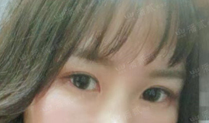 上海马大哈姑娘，稀里糊涂整了容，术后就一个字：丑