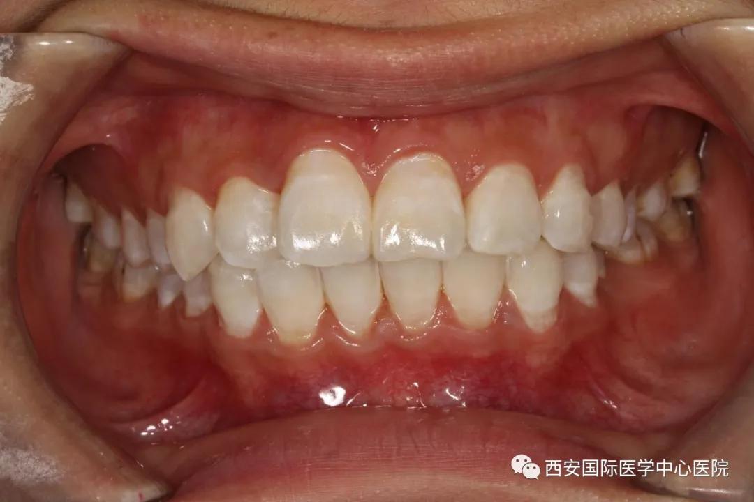 门牙黄斑是氟斑牙怎么治疗,氟斑牙黄牙怎么变白