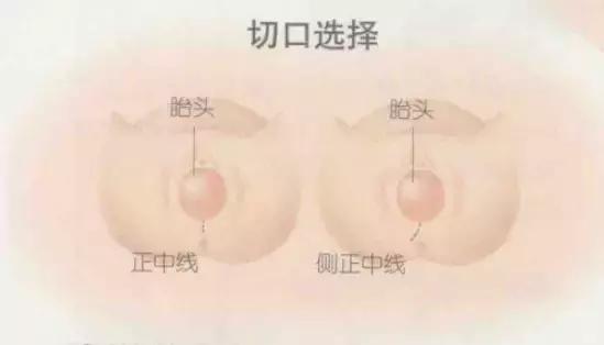 顺产挨一刀还是侧切,生孩子被侧切伤口会裂开吗