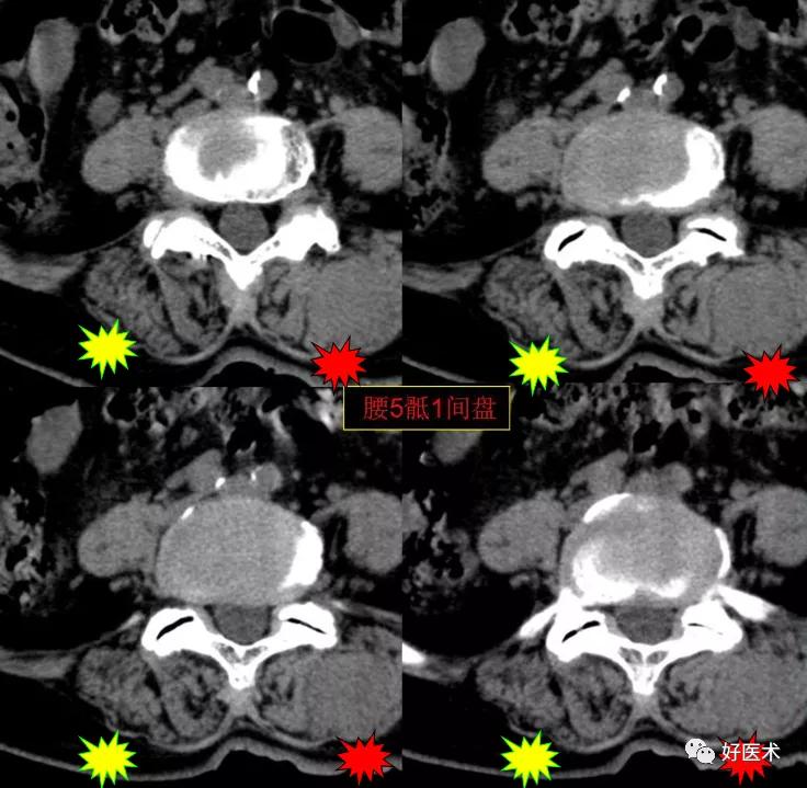 腰部ct需要注意事项,做腰部ct需要注意的事项